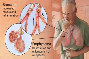 Asthma Image